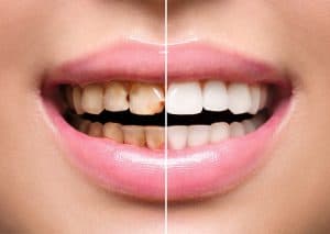 Discoloured Teeth vs White Teeth