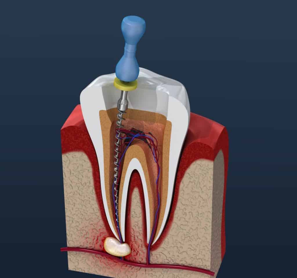 How long do root canals last