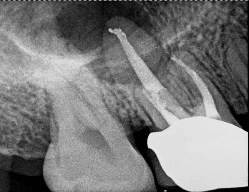 What Causes a Root Canal Infection